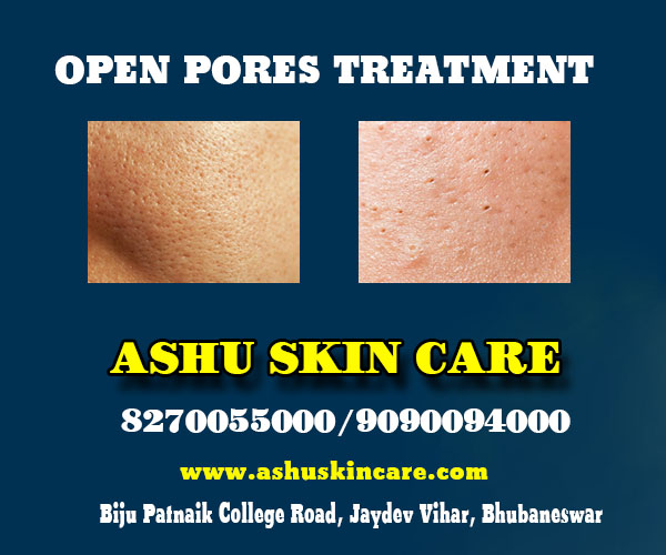 best open pores treatment clinic in bhubaneswar near hitech hospital